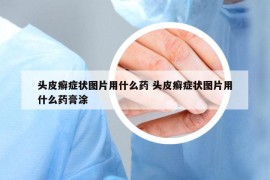 頭皮癬癥狀圖片用什么藥 頭皮癬癥狀圖片用什么藥膏涂