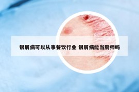 銀屑病可以從事餐飲行業(yè) 銀屑病能當(dāng)廚師嗎