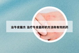 冶牛皮偏方 治療牛皮最好的方法和有效的藥