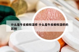 什么是牛皮癬和濕疹 什么是牛皮癬和濕疹的區(qū)別