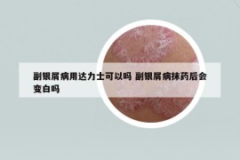 副銀屑病用達(dá)力士可以嗎 副銀屑病抹藥后會變白嗎