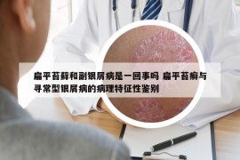 扁平苔蘚和副銀屑病是一回事嗎 扁平苔癬與尋常型銀屑病的病理特征性鑒別