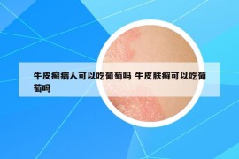 牛皮癬病人可以吃葡萄嗎 牛皮膚癬可以吃葡萄嗎