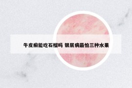 牛皮癬能吃石榴嗎 銀屑病最怕三種水果