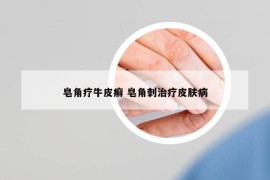 皂角療牛皮癬 皂角刺治療皮膚病