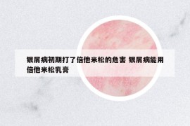 銀屑病初期打了倍他米松的危害 銀屑病能用倍他米松乳膏