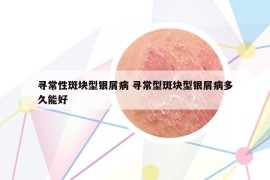 尋常性斑塊型銀屑病 尋常型斑塊型銀屑病多久能好