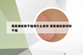 銀屑病皮膚干燥用什么癥狀 銀屑病皮膚特別干燥