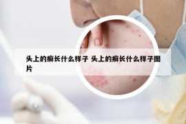 頭上的癬長什么樣子 頭上的癬長什么樣子圖片