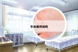 牛皮癬傳說嗎