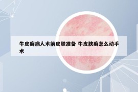 牛皮癬病人術(shù)前皮膚準(zhǔn)備 牛皮膚癬怎么動手術(shù)