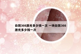 白斑308激光多少錢(qián)一次 一塊白斑308激光多少錢(qián)一次