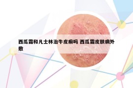 西瓜霜和凡士林治牛皮癬嗎 西瓜霜皮膚病外敷