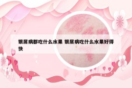 銀屑病都吃什么水果 銀屑病吃什么水果好得快