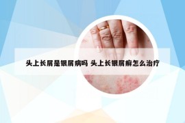 頭上長(zhǎng)屑是銀屑病嗎 頭上長(zhǎng)銀屑癬怎么治療