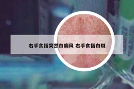 右手食指突然白癜風(fēng) 右手食指白斑