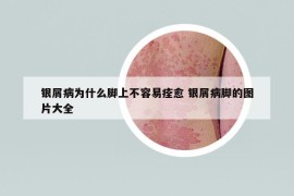 銀屑病為什么腳上不容易痊愈 銀屑病腳的圖片大全