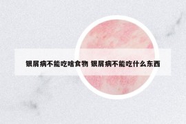 銀屑病不能吃啥食物 銀屑病不能吃什么東西