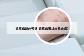 銀屑病能吃鴨湯 銀屑病可以吃鴨肉嗎?