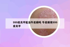 999皮炎平能治牛皮癬嗎 牛皮癬用999皮炎平