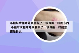 小腿與大腿彎處內(nèi)側(cè)長了一塊像癬一樣的東西 小腿與大腿彎處內(nèi)側(cè)長了一塊像癬一樣的東西是什么
