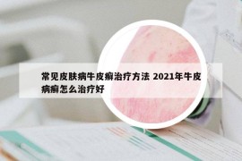 常見皮膚病牛皮癬治療方法 2021年牛皮病癬怎么治療好