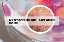 長(zhǎng)春那個(gè)醫(yī)院看銀屑病最好 長(zhǎng)春銀屑病醫(yī)院預(yù)約掛號(hào)
