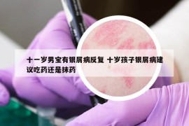 十一歲男寶有銀屑病反復(fù) 十歲孩子銀屑病建議吃藥還是抹藥