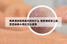 銀屑病皮膚表面長的叫什么 銀屑病皮損上面密密麻麻小嘎達(dá)怎么回事
