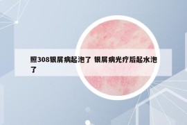 照308銀屑病起泡了 銀屑病光療后起水泡了