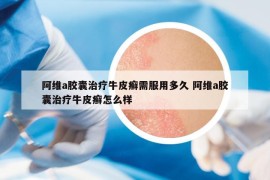 阿維a膠囊治療牛皮癬需服用多久 阿維a膠囊治療牛皮癬怎么樣