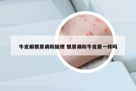 牛皮癬銀屑病和腦梗 銀屑病和牛皮屑一樣嗎