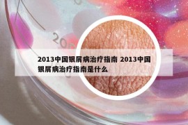 2013中國銀屑病治療指南 2013中國銀屑病治療指南是什么