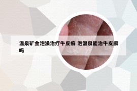 溫泉礦金泡澡治療牛皮癬 泡溫泉能治牛皮廨嗎