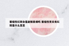 萎縮性紅斑會(huì)是副銀屑病嗎 萎縮性胃炎有紅斑是什么意思