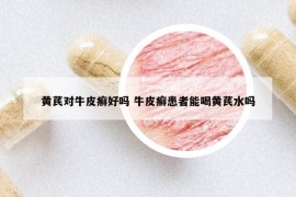 黃芪對牛皮癬好嗎 牛皮癬患者能喝黃芪水嗎