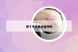 得了牛皮癬會(huì)遺傳嗎