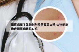 銀屑病用了生物制劑后需要忌口嗎 生物制劑治療銀屑病用忌口嗎