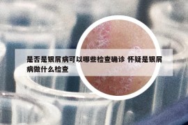 是否是銀屑病可以哪些檢查確診 懷疑是銀屑病做什么檢查