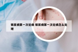 銀屑病第一次犯病 銀屑病第一次犯病怎么處理