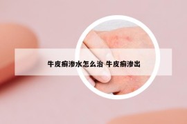 牛皮癬滲水怎么治 牛皮癬滲出