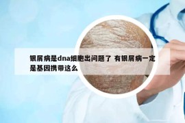 銀屑病是dna細胞出問題了 有銀屑病一定是基因攜帶這么