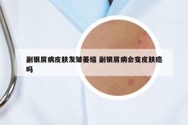 副銀屑病皮膚發(fā)皺萎縮 副銀屑病會變皮膚癌嗎