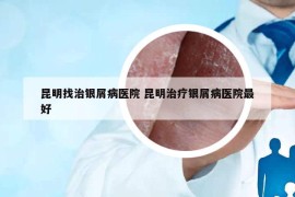 昆明找治銀屑病醫(yī)院 昆明治療銀屑病醫(yī)院最好
