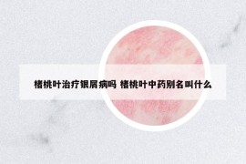 楮桃葉治療銀屑病嗎 楮桃葉中藥別名叫什么