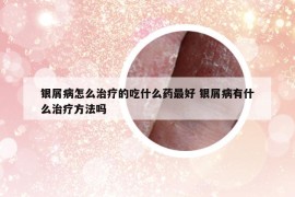 銀屑病怎么治療的吃什么藥最好 銀屑病有什么治療方法嗎