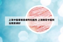上海中醫(yī)看銀屑病?？漆t(yī)院 上海哪家中醫(yī)院治銀屑病好