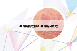 牛皮癬能吃椰子 牛皮癬可以吃
