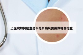 上醫(yī)院如何檢查是不是白癜風(fēng)需要做哪些檢查