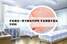 手足癬這一輩子都治不好嗎 手足癬是不是治不好的